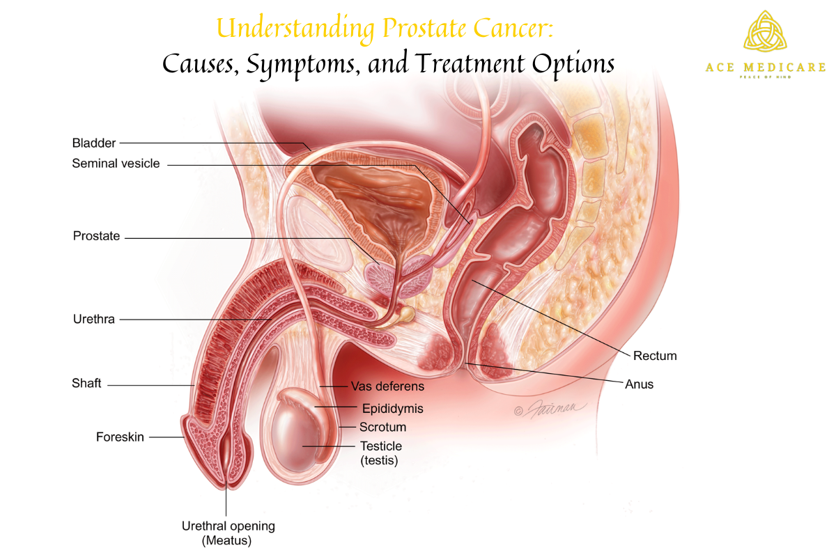 Understanding Prostate Cancer: Causes, Symptoms, and Treatment Options